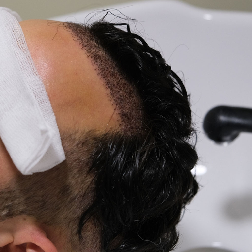 DHI Hair Transplant